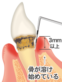 歯周炎（歯槽膿漏）