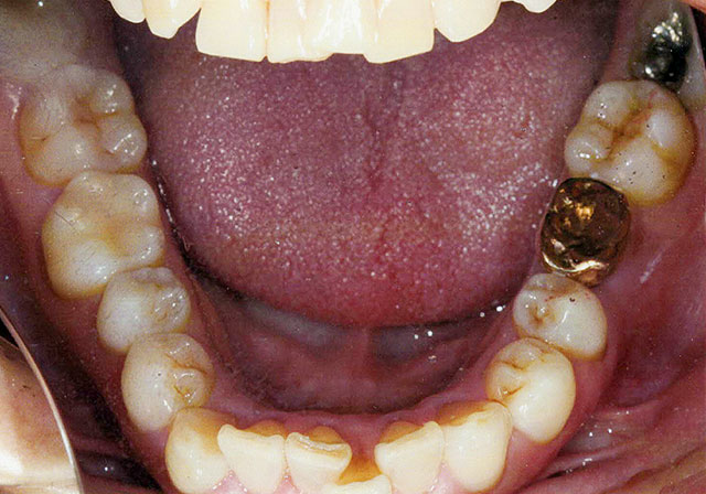 下顎1本のインプラント（金歯を使ったインプラント）治療例 ...